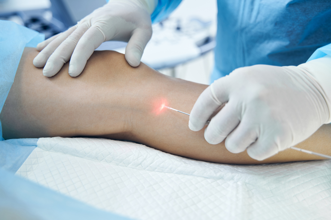 Avantajele laserului vascular față de alternative